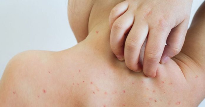 OPS ratifica a Venezuela como país libre de sarampión