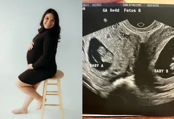 ¡ASOMBROSO! Una mujer con doble útero quedó embarazada en ambos al mismo tiempo