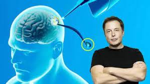 ¡AVANCES! Elon Musk anuncia el primer implante de un chip en el cerebro de un humano