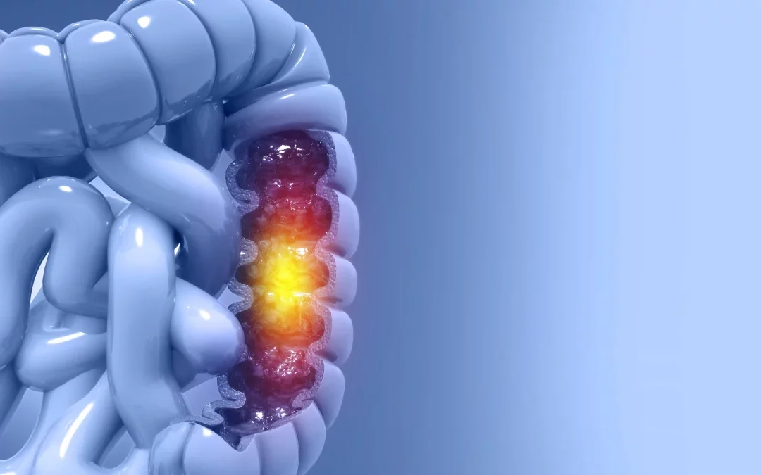 Cáncer de colon metastatiza al hígado por falta de proteína clave